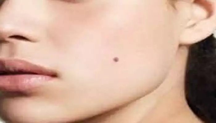 Female Face Moles